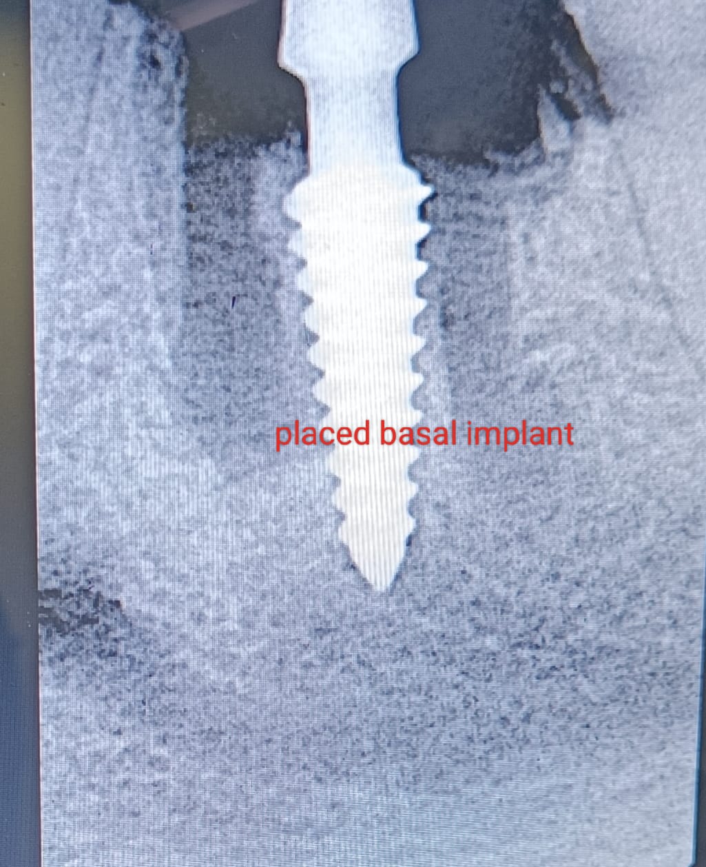 Dental implant after treatment